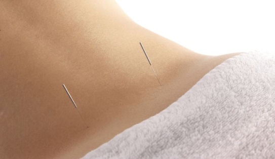 Needling Kidney points for knee and back pain