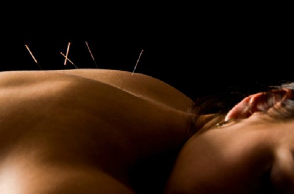 Traditional Chinese Acupuncture